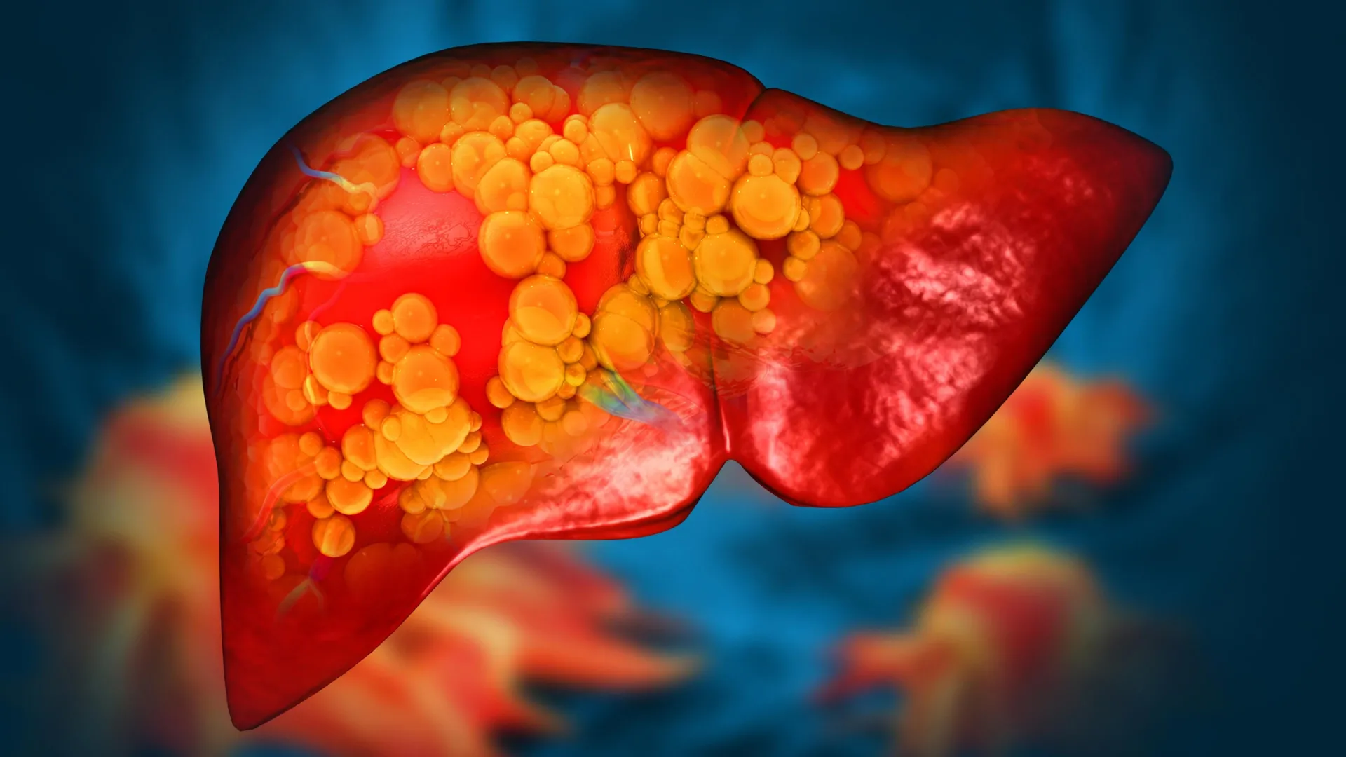 New Drug Reverses Severe Fatty Liver by Restoring Gut Health