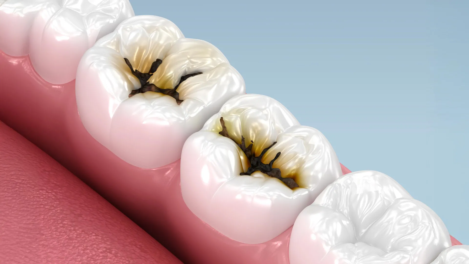 Liquid Treatment Stops Cavities Without Drilling, Study Finds