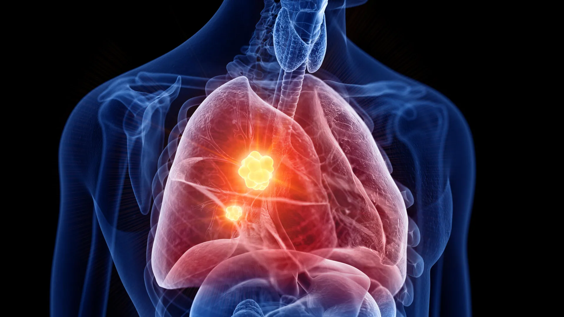 Experimental Drug Turns Mesothelioma’s Own Antioxidant Shield Against It