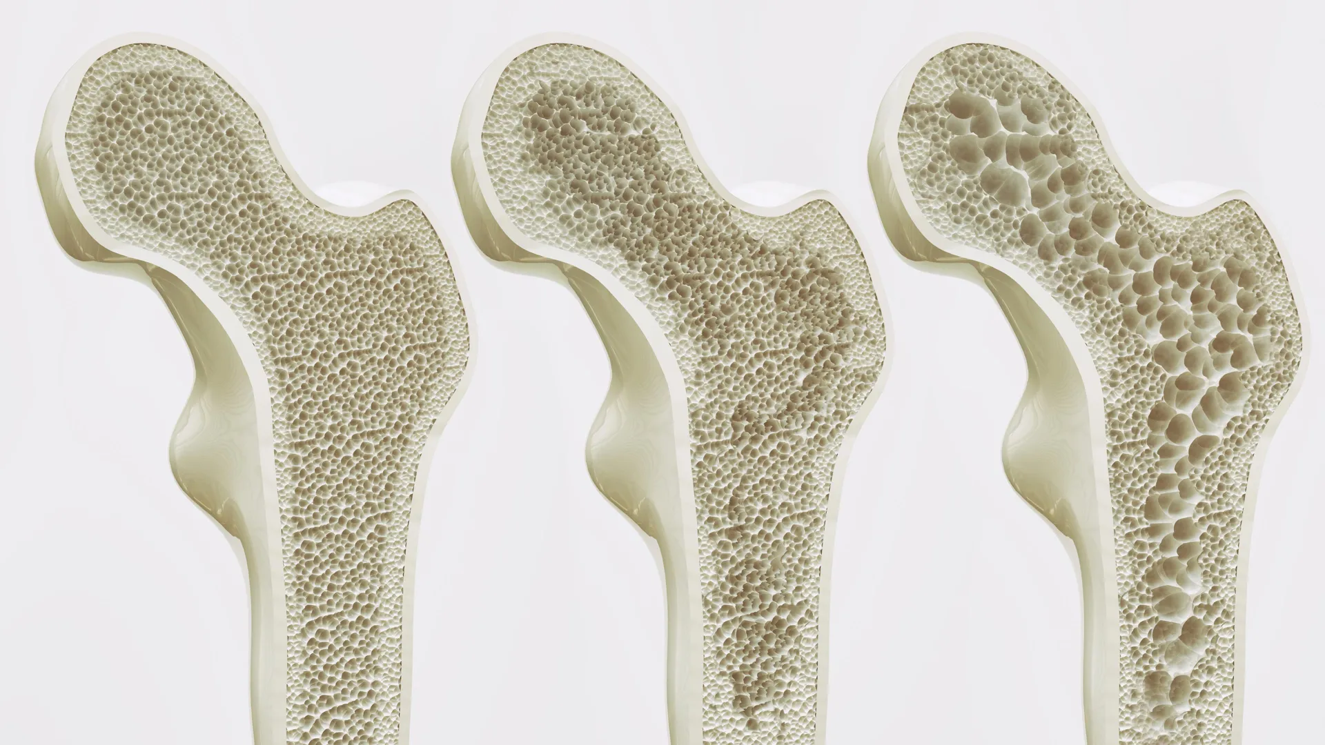 Excess Coffee Linked to Lower Bone Density in Older Women